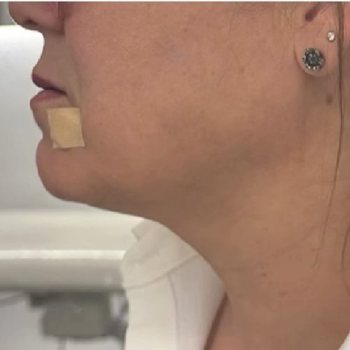 Lipolytic-Adipozon-💉-est-une-nouvelle-technique-de-lipolyse-qui-permet-deviter-les-effets-seco-1.jpg